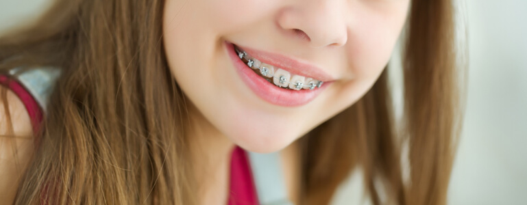 Close up of young girl's smile with braces