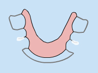 Model of what a loose oral appliance looks like
