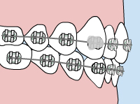 Model of what a loose bracket in your braces looks like