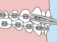 Model of what a loose wire in your braces looks like