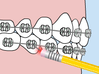 Model of what it looks like when a wire from your braces is poking your gums