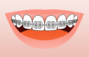 Infographic showing how to brush your teeth with braces