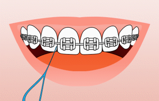 Infographic showing how to floss with braces