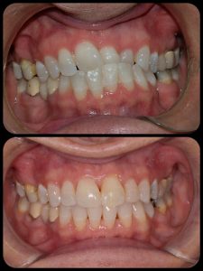 braces case 1-b