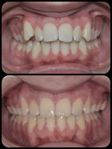 Braces Case 3 b