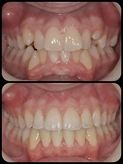 Braces Case 4 a