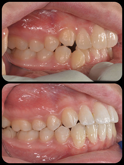 Braces Case 4 b