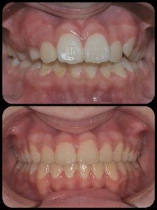 Braces case 5 a