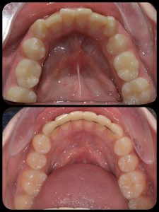 Braces case 5 b