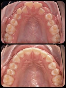 Braces Case 7 a