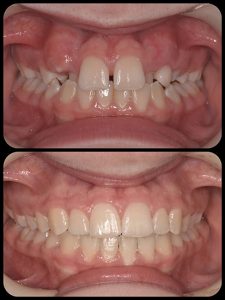 Braces Case 7 b