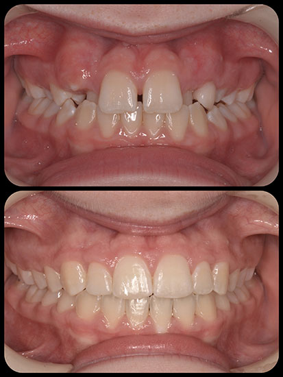 Braces Case 7 b