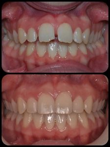 Braces case 8 a