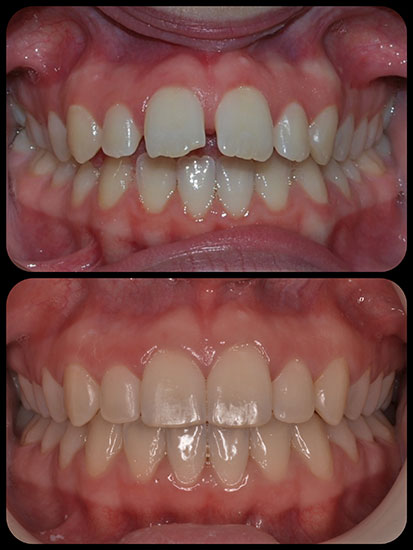 Braces case 8 a