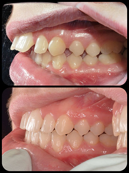 Braces case 8 b